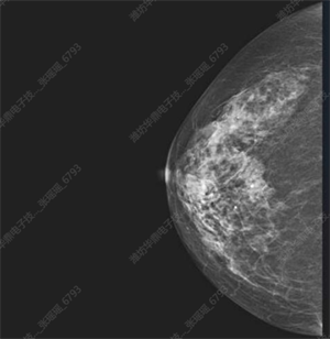 乳腺平板探测器成像 (1).png