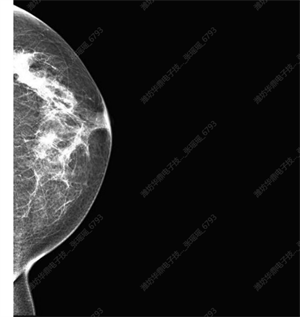 乳腺平板探测器成像 (2).png
